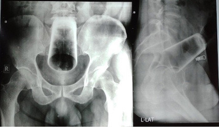 x-ray yang menunjukkan gelas yang tersangkut dalam dubur.