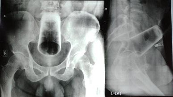 6 Potret X-Ray Mencengangkan, Tunjukkan Benda yang Nyangkut di Tubuh Pasien