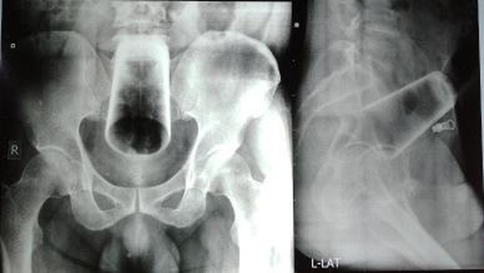 Demi Kepuasan Pribadi, Pria di Nepal Nekat Masukkan Gelas 12 Cm ke Dalam Anus