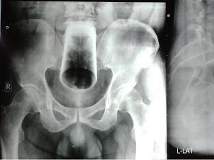 6 Potret X-Ray Mencengangkan, Tunjukkan Benda yang Nyangkut di Tubuh Pasien