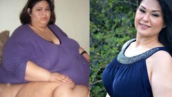 Before-After Wanita Tergemuk di Dunia, Bikin Takjub! Sukses Pangkas 363 Kg