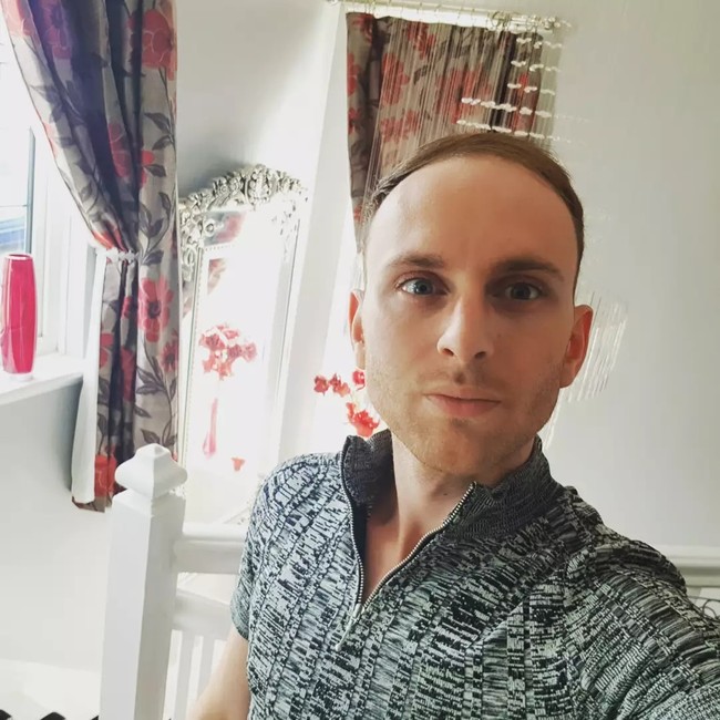 Dilansir Daily Star, pria tersebut sempat kehilangan kepercayaan diri karena kondisi rambutnya. Ia sempat terpikir untuk membotaki kepala sebelum akhirnya memutuskan untuk melakukan hair system di sebuah salon. Foto: Instagram Ashley Tawney