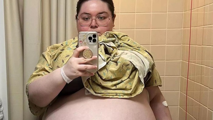 Wanita 20 Tahun Punya Kista Seberat 47 Kg Bersarang di Perut, Bikin Dokter Syok