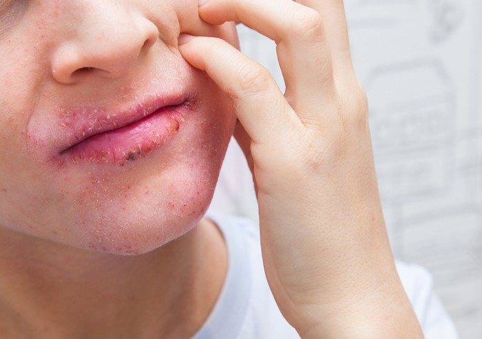 Boy scratching his face. Human skin, presenting an allergic reaction, allergic rash on face and lips. Health care and medicine concept.