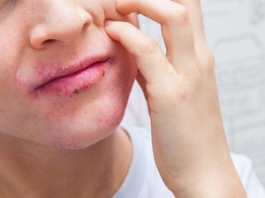 5 Jenis Alergi Makanan Paling Umum, Ada yang Bertahan Seumur Hidup