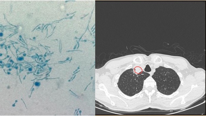 Penampakan Jamur Tanaman Mematikan di Tubuh Pria India, Pertama di Dunia