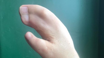 Sejak lahir orang ini punya tangan dengan tiga jari. Dua jari di antaranya menyatu. Foto: Brightside