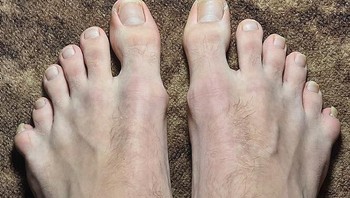 Kaki dengan masing-masing enam jari. Foto: Brightside