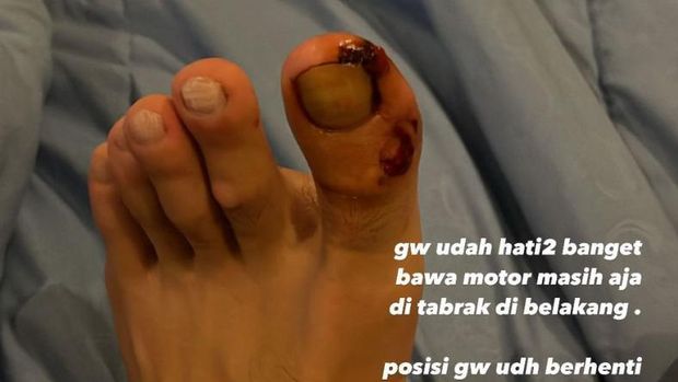 Luka Stefan William usai ditabrak motor dari belakang.