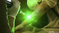 Laser berwarna kuning dan hijau dengan suara layaknya mesin jahit menggema di ruang serbaguna utama, laser tersebut langsung menghantam kulit bergambar atau tato.