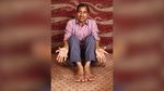 Potret Manusia dengan Jari Terbanyak di Dunia, Kerap Sulit Berjalan