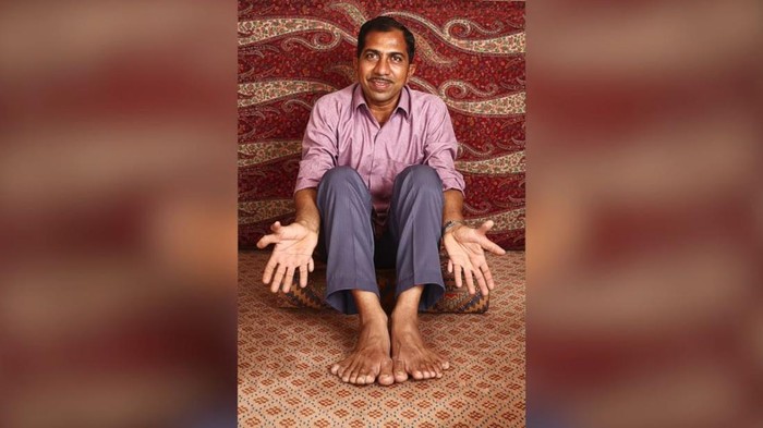Devendra suthar memegang rekor sebagai manusia dengan jari terbanyak di dunia. Ia mengidap kelainan genetik polidaktili. Begini 6 potretnya.