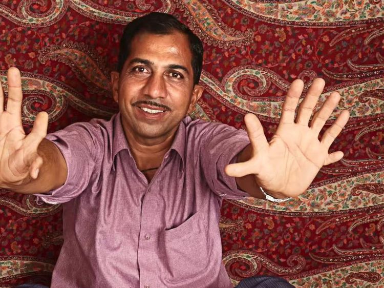 Potret Manusia dengan Jari Terbanyak di Dunia, Kerap Sulit Berjalan