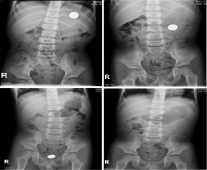 X-ray koin Sebuah foto x-ray menunjukkan koin dalam tubuh manusia