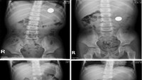 Balita berusia 4 tahun di Taiwan dilaporkan tidak sengaja menelan koin besar. Setelah 28 hari berada di dalam perutnya, koin tersebut berhasil keluar berkat bantuan obat pencahar yang diresepkan dokter. (Foto: International Journal of Emergency Medicine)