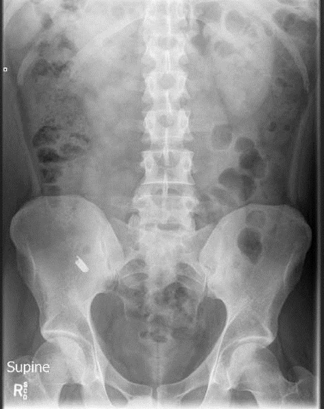 X-ray pisau silet Sebuah foto x-ray menunjukkan pisau silet dalam tubuh manusia.