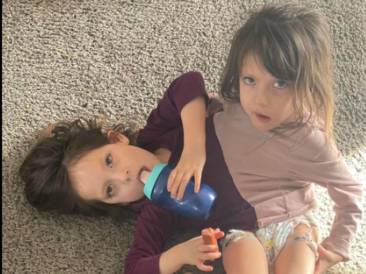 6 Potret Kembar Siam dengan Satu Tubuh, Sempat Disebut Tak Bisa Hidup Lama