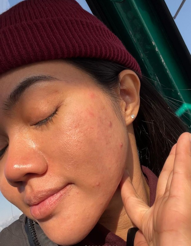 Bahkan dalam salah satu unggahannya terlihat Yura Yunita yang memamerkan kondisi wajahnya yang berjerawqt saat di Jepang. Wow jerawat mendadak bermuntjulan manja saat perjalanan ke luar kota  Siapa disini yang juga lagi struggle sama jeriwititiw? Angkat tangannya... tulis keterangan dalam unggahan tersebut. Foto: Instagram/@yurayunita