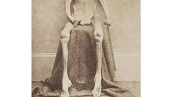 Beginilah rupa seorang prajurit serikat pekerja setelah selamat dari Kamp Penjara Andersonville Foto: Onedio