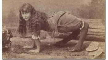 Ella Harper menderita kelainan yang melemahkan ligamen di lutut yang membuatnya tampak seperti unta. Dan karena kelainan ini, dia dikenal sebagai Camel Girl. [1870–1921] Foto: Onedio