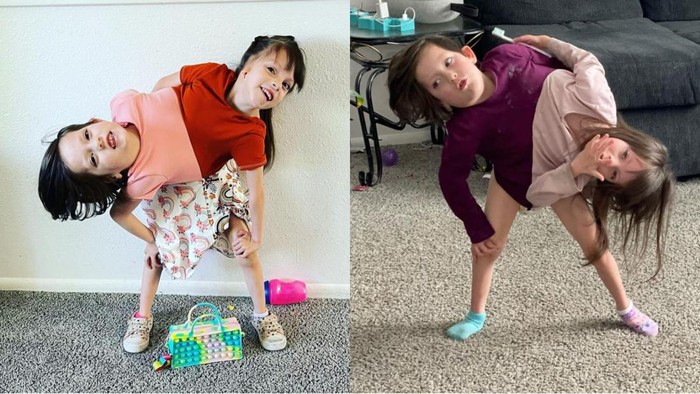 Bikin Haru! Viral Ibu Besarkan Kembar Siam, Sempat Diduga Tak Akan Hidup Lama