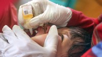 Kabar Baik! KLB Polio Resmi Dinyatakan Berakhir di Indonesia