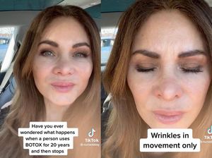 Viral Wanita Berhenti Suntik Botox Setelah 20 Tahun, Penampakan Wajahnya Jadi Begini