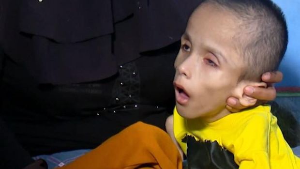 Irfan dan Arfan adalah anak kembar yang mengalami hidrosefalus, cerebral palsy, katarak, epilepsi hingga gizi buruk. Yuk, bantu mereka melalui berbuatbaik.id.