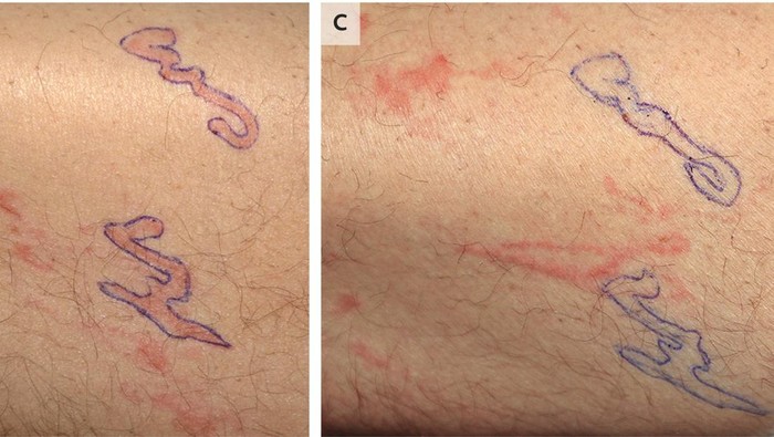Ngeri, Begini Penampakan Cacing Bersarang di Bawah Kulit Pria Ini