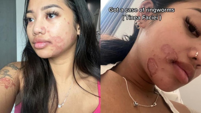 Viral Wajah Wanita Kena Ringworm gegara Berbagi Alat Make-up dengan Teman