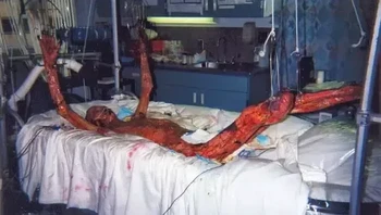 Hisashi Ouchi adalah salah satu teknisi yang bekerja di fasilitas yang dioperasikan oleh JCO (sebelumnya Perusahaan Konversi Bahan Bakar Nuklir Jepang) di Tokai, Prefektur Ibaraki. Dia adalah salah satu dari dua korban yang tewas akibat kecelakaan nuklir Tokaimura yang membuatnya terkena, mungkin, jumlah radiasi tertinggi yang pernah dialami manusia sejauh ini. Dia sempat dirawat selama hampir tiga bulan menawan rasa sakit sebelum akhirnya meninggal. Foto: via steemit