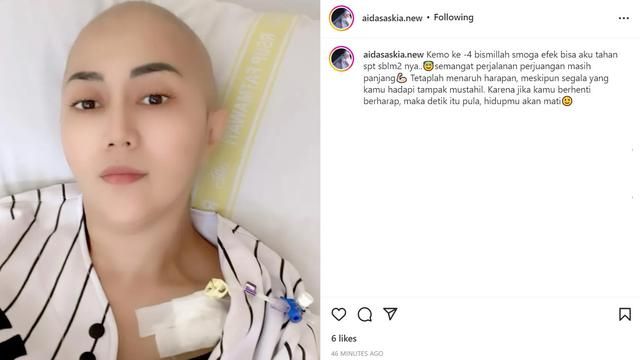 Artis wanita pejuang kanker yang sempat tampil berkepala plontos