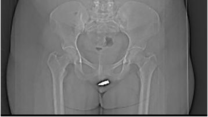 Begini Kondisi Wanita dengan Peluru Nyangkut di Klitoris Pasca Operasi