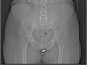 Ngilu! Wanita Tak Sengaja Tertembak, Peluru Nyangkut di Klitoris