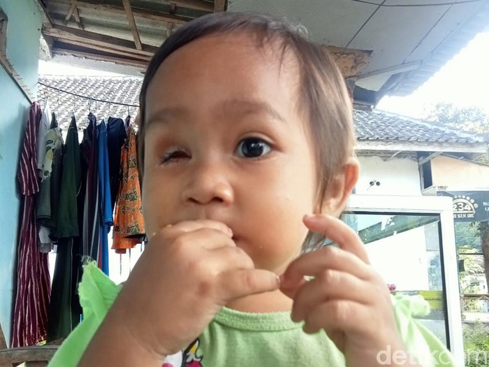 Rasa prihatin tercurah untuk Hani Istighfaroh, warga Dusun Panggul Melati, Desa Kepanjen, Kecamatan Gumuk Mas. Putri berusia 3 tahun ini kehilangan bola mata sebelah kanan akibat kanker.