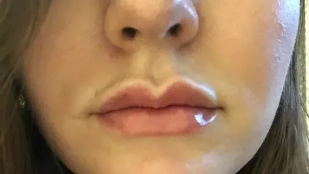 Operasi plastik gagal.