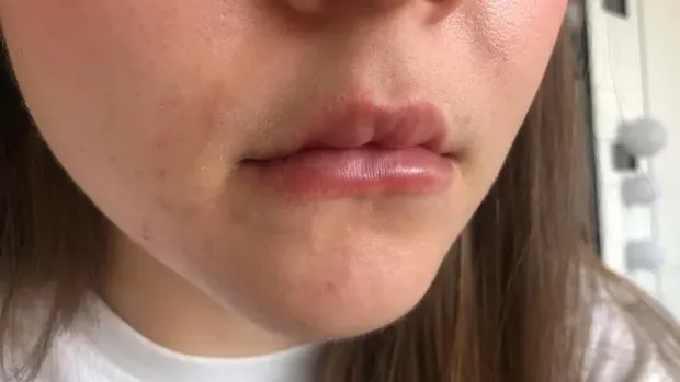 Operasi plastik gagal.