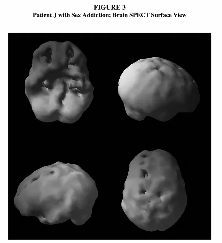Brain SPECT.