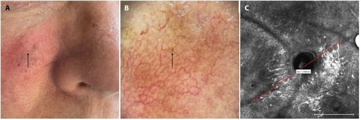 Begini penampakan kanker kulit terkecil di dunia.