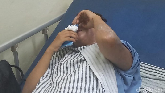 Wajah mama muda di Palembang melepuh disiram air keras oleh OTK.