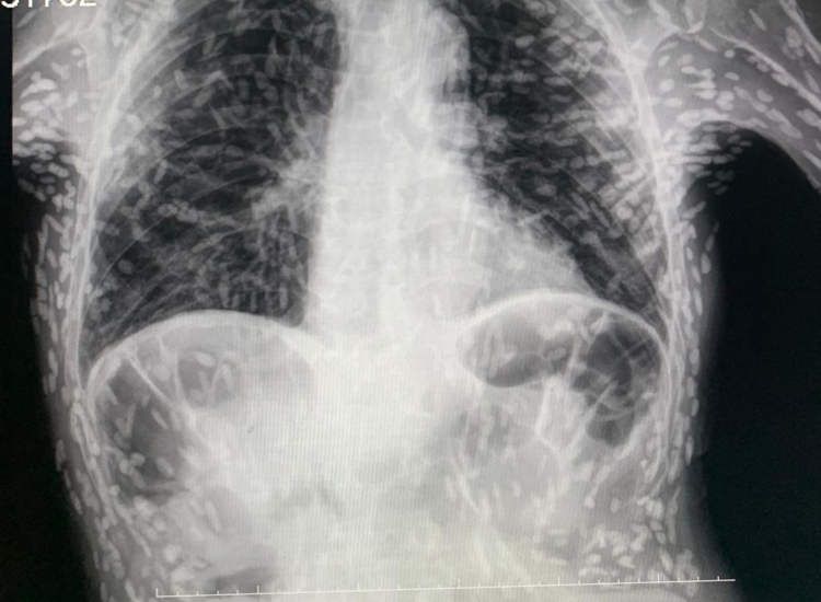 X-ray cacing pita