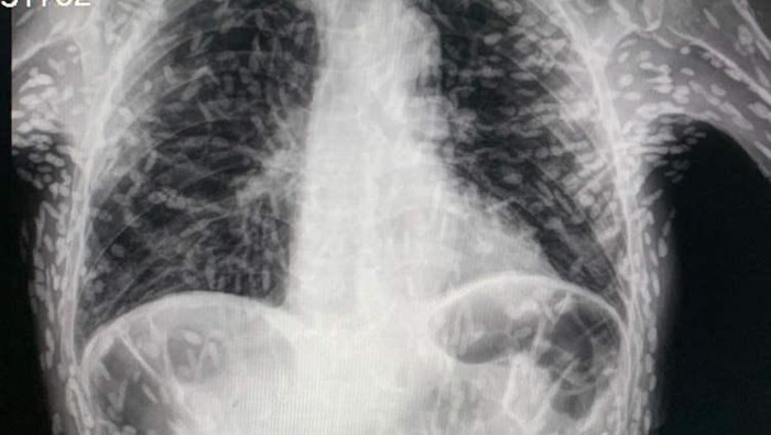 Hii... Dokter Temukan Ratusan Parasit Cacing Pita Bersarang di Tubuh Pasien