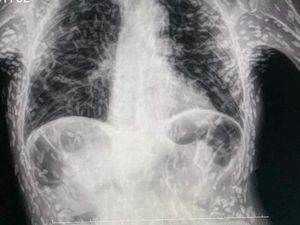 Hii... Dokter Temukan Ratusan Parasit Cacing Pita Bersarang di Tubuh Pasien