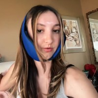 Sebelum operasi plastik, sejak usia delapan tahun ia sudah melakukan berbagai perawatan untuk memperbaiki rahangnya, termasuk dengan memakai behel sebanyak enam kali.Foto: Dok. TikTok