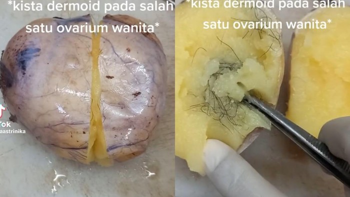 Ramai di Medsos, Gorengan-Junkfood Picu Kista Ovarium? Nggak Selalu Sih, Ini Faktanya