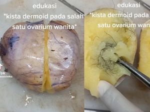 Ramai di Medsos, Gorengan-Junkfood Picu Kista Ovarium? Nggak Selalu Sih, Ini Faktanya