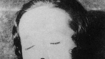 Ratusan gadis dan wanita muda yang bekerja di pabrik arloji Amerika selama tahun 1920-an terpapar begitu banyak radium. Paparan radium yang terlalu lama menyebabkan tulang belakang mereka runtuh, rahang mereka membengkak, dan hidup mereka perlahan-lahan berakhir dengan penderitaan saat melawan kanker. Foto: Allthatinteresting