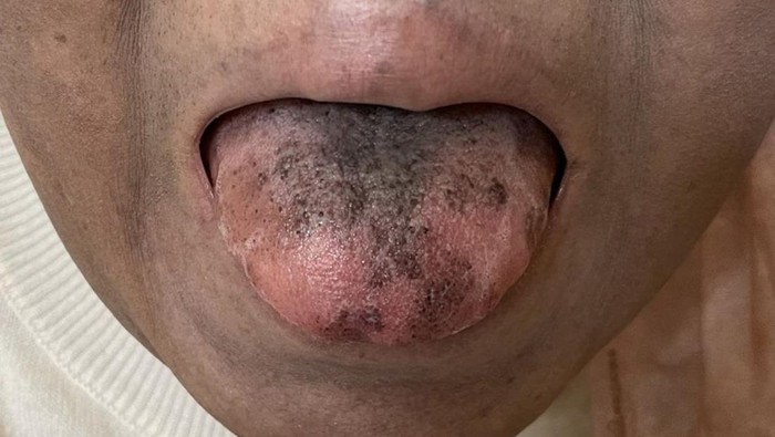 Sederet Kasus Langka Lidah Berbulu, Disebabkan Rokok hingga Konsumsi Antibiotik