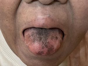Ngeri! Lidah Wanita Ini Jadi Hitam dan Berbulu usai Minum Antibiotik