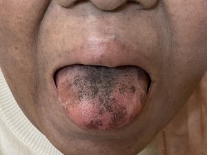 Sederet Kasus Langka Lidah Berbulu, Disebabkan Rokok hingga Konsumsi Antibiotik